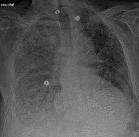 Savoir diagnostiquer un épanchement pleural liquidien chez l'enfant et l'adulte Figure 10a