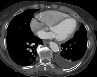 Savoir diagnostiquer un épanchement pleural liquidien chez l'enfant et l'adulte Figure 11