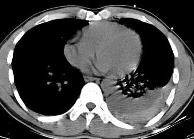 Savoir diagnostiquer un épanchement pleural liquidien chez l'enfant et l'adulte Figure 12