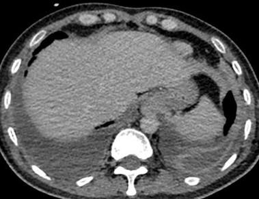 Savoir diagnostiquer un épanchement pleural liquidien chez l'enfant et l'adulte Figure 13