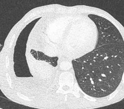 Savoir diagnostiquer un épanchement pleural liquidien chez l'enfant et l'adulte Figure 14a