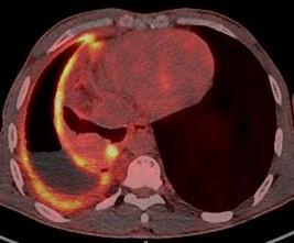 Savoir diagnostiquer un épanchement pleural liquidien chez l'enfant et l'adulte Figure 14b