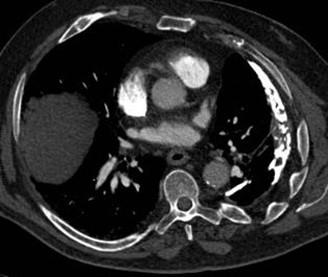 Savoir diagnostiquer un épanchement pleural liquidien chez l'enfant et l'adulte Figure 15