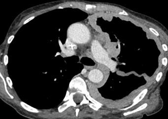 Savoir diagnostiquer un épanchement pleural liquidien chez l'enfant et l'adulte Figure 16