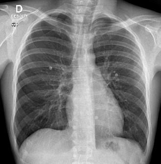 Savoir diagnostiquer un épanchement pleural gazeux chez l'enfant et l'adulte Figure 17