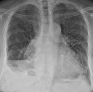 Savoir diagnostiquer un épanchement pleural gazeux chez l'enfant et l'adulte Figure 18