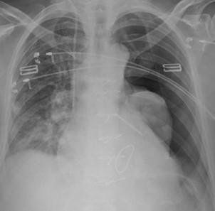 Savoir diagnostiquer un épanchement pleural gazeux chez l'enfant et l'adulte Figure 19