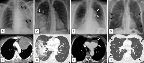 Reconnaitre une opacité pulmonaire chez l'enfant et l'adulte