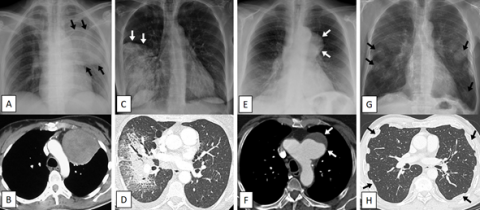 Reconnaitre une opacité pulmonaire chez l'enfant et l'adulte ...