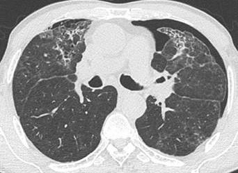 Savoir diagnostiquer un épanchement pleural gazeux chez l'enfant et l'adulte Figure 20