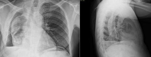 Savoir diagnostiquer un épanchement pleural gazeux chez l'enfant et l'adulte Figure 21