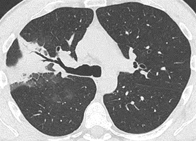 Savoir diagnostiquer un syndrome alvéolaire Figure 23