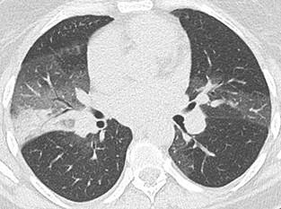 Savoir diagnostiquer un syndrome alvéolaire Figure 24