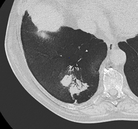 Savoir diagnostiquer un syndrome alvéolaire Figure 25