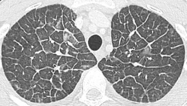 Savoir diagnostiquer un syndrome interstitiel Figure 26