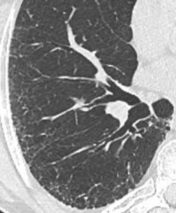 Savoir diagnostiquer un syndrome interstitiel Figure 27