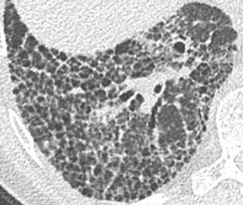 Savoir diagnostiquer un syndrome interstitiel Figure 28