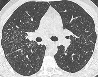 Savoir diagnostiquer un syndrome interstitiel Figure 29