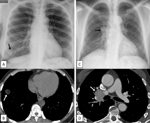 Reconnaitre une opacité pulmonaire chez l'enfant et l'adulte Figure 2