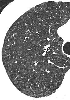 Savoir diagnostiquer un syndrome interstitiel Figure 30