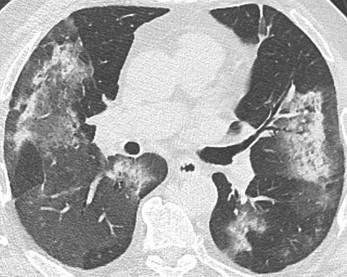 Savoir diagnostiquer un syndrome interstitiel Figure 31