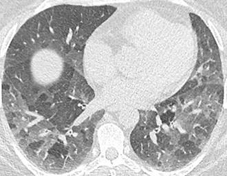 Savoir diagnostiquer un syndrome interstitiel Figure 32