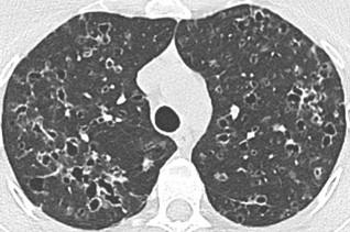 Savoir diagnostiquer un syndrome interstitiel Figure 33