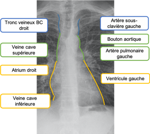 Savoir repérer une anomalie médiastinale Figure 35