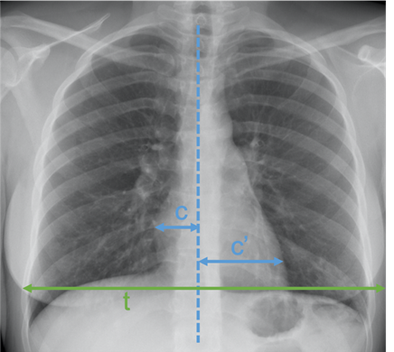 Savoir repérer une anomalie médiastinale Figure 36