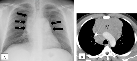 Savoir repérer une anomalie médiastinale Figure 37