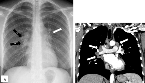 Savoir repérer une anomalie médiastinale Figure 39