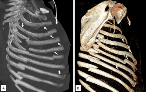 Reconnaître une fracture de côte chez l'enfant et l'adulte Figure 4