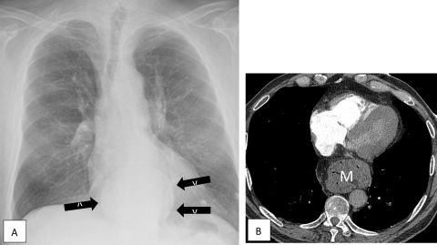 Savoir repérer une anomalie médiastinale Figure 40