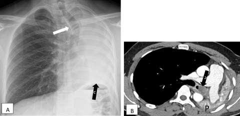 Savoir diagnostiquer une atélectasie Figure 41