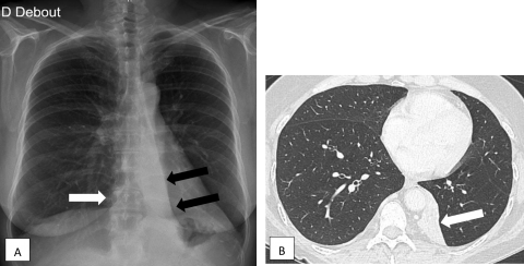 Savoir diagnostiquer une atélectasie Figure 42