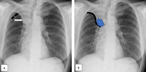 Savoir diagnostiquer une atélectasie Figure 43