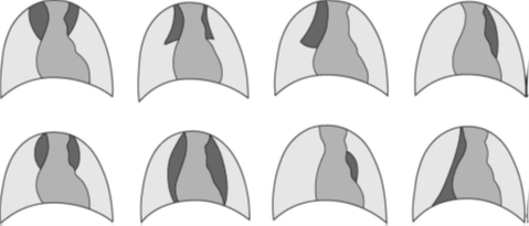 Savoir identifier une image thymique normale sur une radiographie thoracique de face chez un nourrisson Figure 44