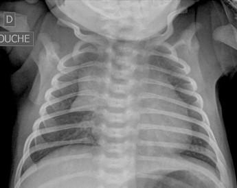 Savoir identifier une image thymique normale sur une radiographie thoracique de face chez un nourrisson Figure 45