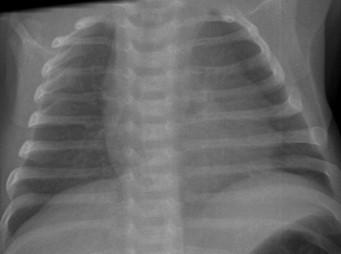 Savoir identifier une image thymique normale sur une radiographie thoracique de face chez un nourrisson Figure 46