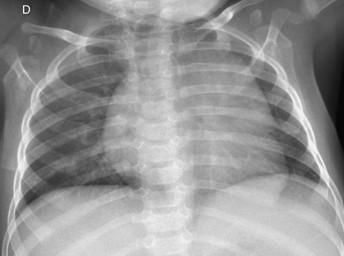 Savoir identifier une image thymique normale sur une radiographie thoracique de face chez un nourrisson Figure 47