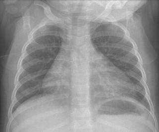 Savoir identifier une image thymique normale sur une radiographie thoracique de face chez un nourrisson Figure 48