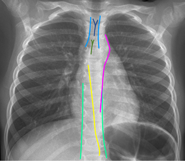 Savoir identifier une image médiastinale anormale chez le nourrisson et l'enfant et prescrire un scanner thoracique Figure 49