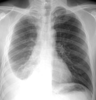 Savoir diagnostiquer un épanchement pleural liquidien chez l'enfant et l'adulte Figure5