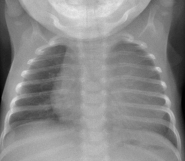 Savoir identifier une image médiastinale anormale chez le nourrisson et l'enfant et prescrire un scanner thoracique Figure 50