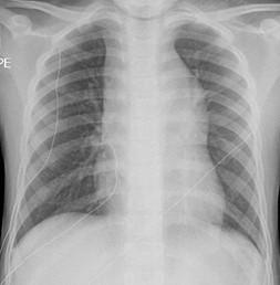 Savoir identifier une image médiastinale anormale chez le nourrisson et l'enfant et prescrire un scanner thoracique Figure 51