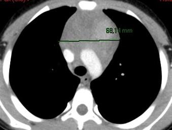 Savoir identifier une image médiastinale anormale chez le nourrisson et l'enfant et prescrire un scanner thoracique Figure 51b