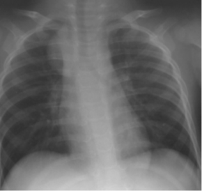 Savoir identifier une image médiastinale anormale chez le nourrisson et l'enfant et prescrire un scanner thoracique Figure 52