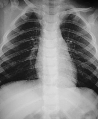 Savoir identifier une image médiastinale anormale chez le nourrisson et l'enfant et prescrire un scanner thoracique Figure 53