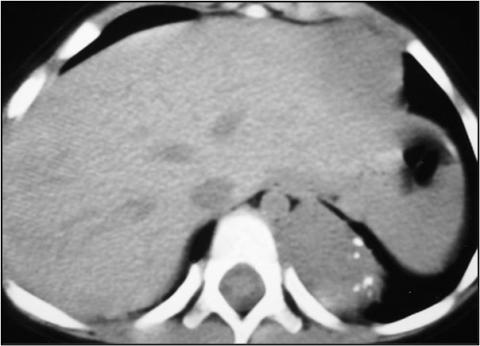 Savoir identifier une image médiastinale anormale chez le nourrisson et l'enfant et prescrire un scanner thoracique Figure 53b