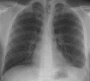 Savoir diagnostiquer un épanchement pleural liquidien chez l'enfant et l'adulte Figure 6